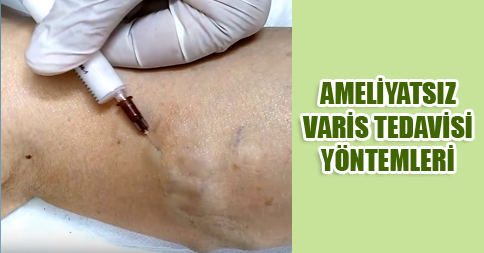 ameliyatsiz-varis-tedavisi-