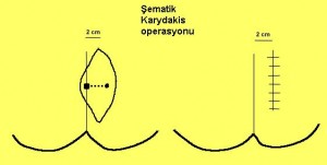 karydakis flep ameliyatı