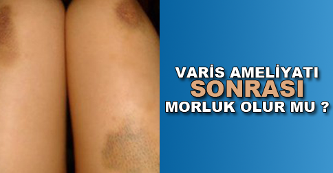 varis-ameliyati-sonrasi-morluk