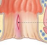anal fissür görüntüsü