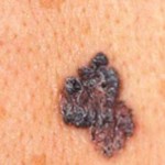 melanom nasıl teşhis edilir