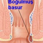 boğulmuş basur nasıl geçer