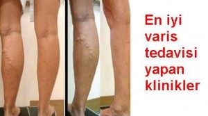 en iyi varis tedavisi yapan klinik